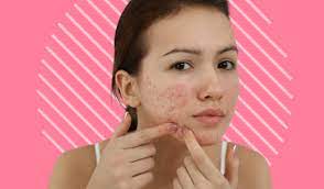 How Can Cystic Acne Be Prevented