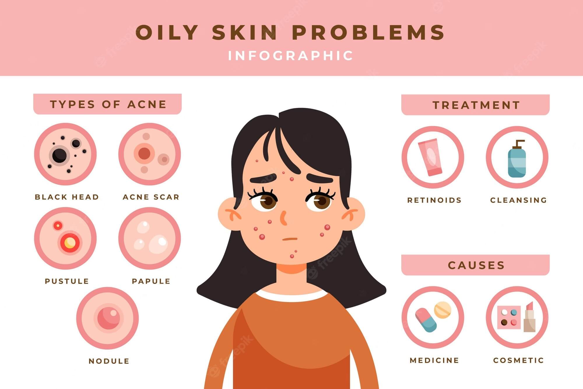 Best Soap For Oily Skin And Pimples infographics 